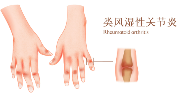 邵陽(yáng)創(chuàng)傷骨科,邵陽(yáng)風(fēng)濕病區(qū),邵陽(yáng)骨質(zhì)增生,邵陽(yáng)關(guān)節(jié)病區(qū),邵陽(yáng)頸椎病區(qū)